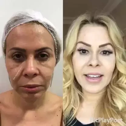 Antes e depois: veja como estes famosos ficaram após a harmonização facial - imagem 63656