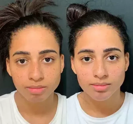 Antes e depois: veja como estes famosos ficaram após a harmonização facial - imagem 63653