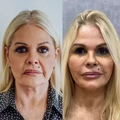 Antes e depois: veja como estes famosos ficaram após a harmonização facial - imagem 63655