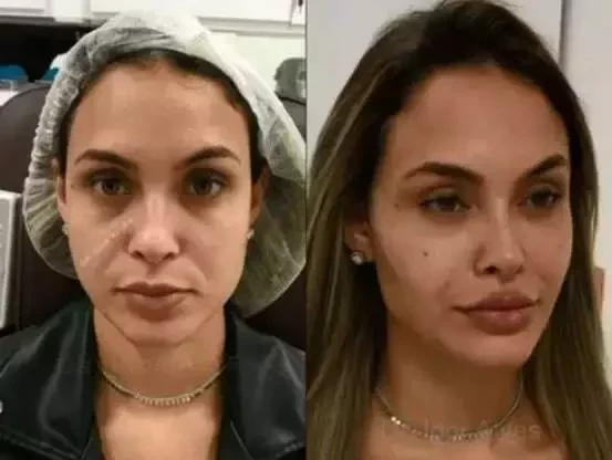 Antes e depois: veja como estes famosos ficaram após a harmonização facial - imagem 63651