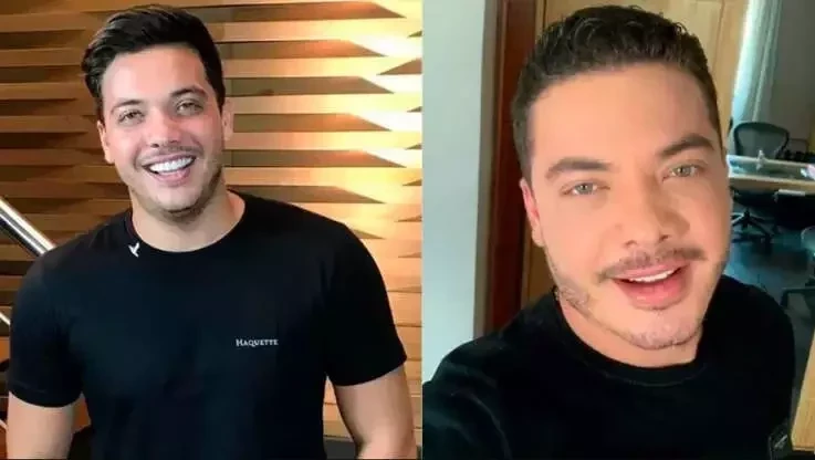 Antes e depois: veja como estes famosos ficaram após a harmonização facial - imagem 63654