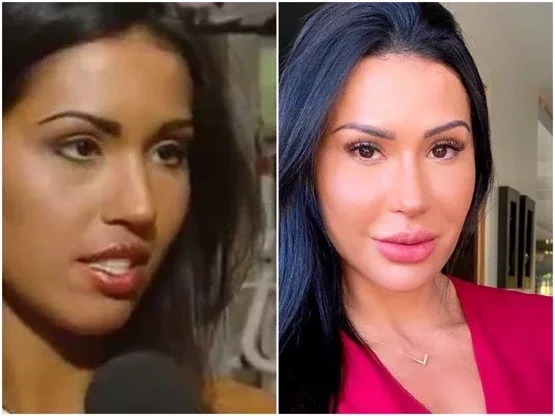 Procedimentos estéticos: surpreenda-se com o antes e depois dos famosos - imagem 62766