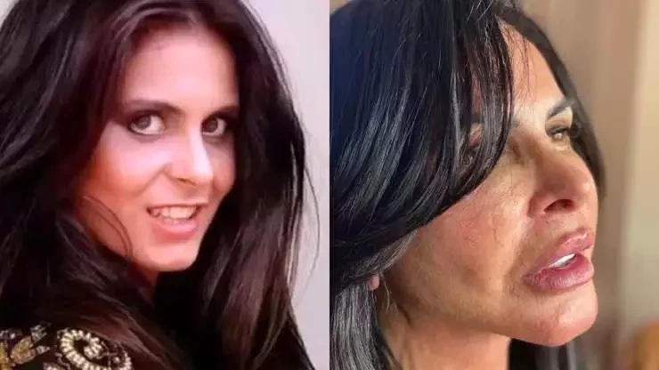 Procedimentos estéticos: surpreenda-se com o antes e depois dos famosos - imagem 62767