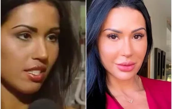 Procedimentos estéticos: surpreenda-se com o antes e depois dos famosos