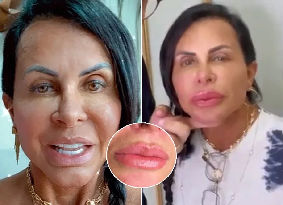 Gretchen faz novos procedimentos estéticos e expõe resultados - imagem 38171