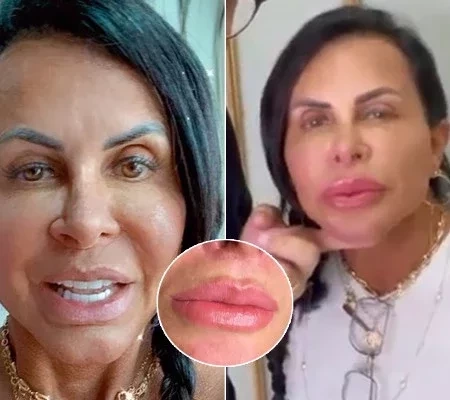 Gretchen faz novos procedimentos estéticos e expõe resultados