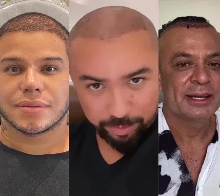 Carecas? Conheça os famosos que aderiram ao transplante capilar