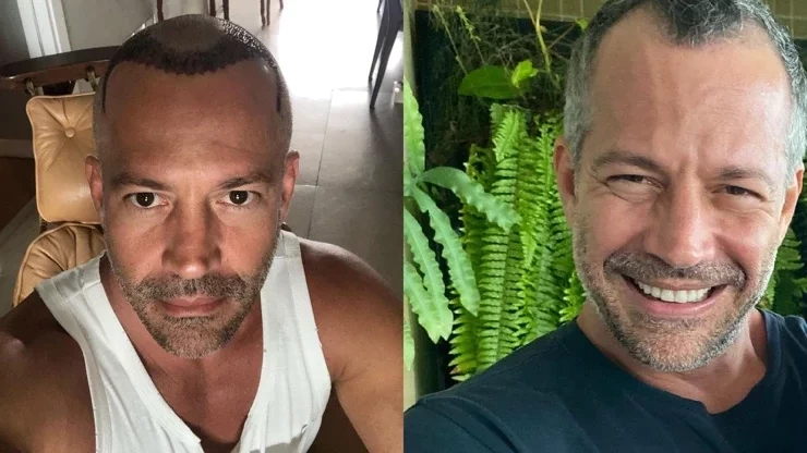 Veja o antes e depois de famosos que fizeram procedimentos estéticos - imagem 41026