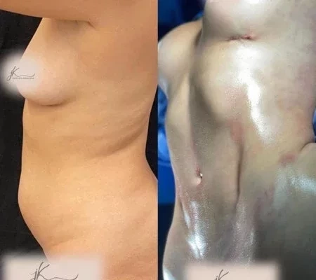 Sarah exibe os procedimentos estéticos realizados pós-BBB; fotos