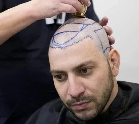 Ex-careca: famosos que já fizeram implante de cabelo e você não sabia
