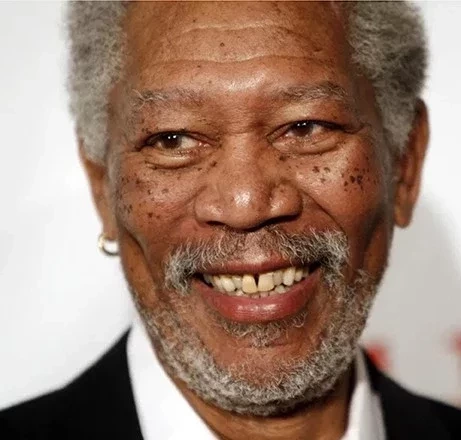 Dentes desalinhados e manchados