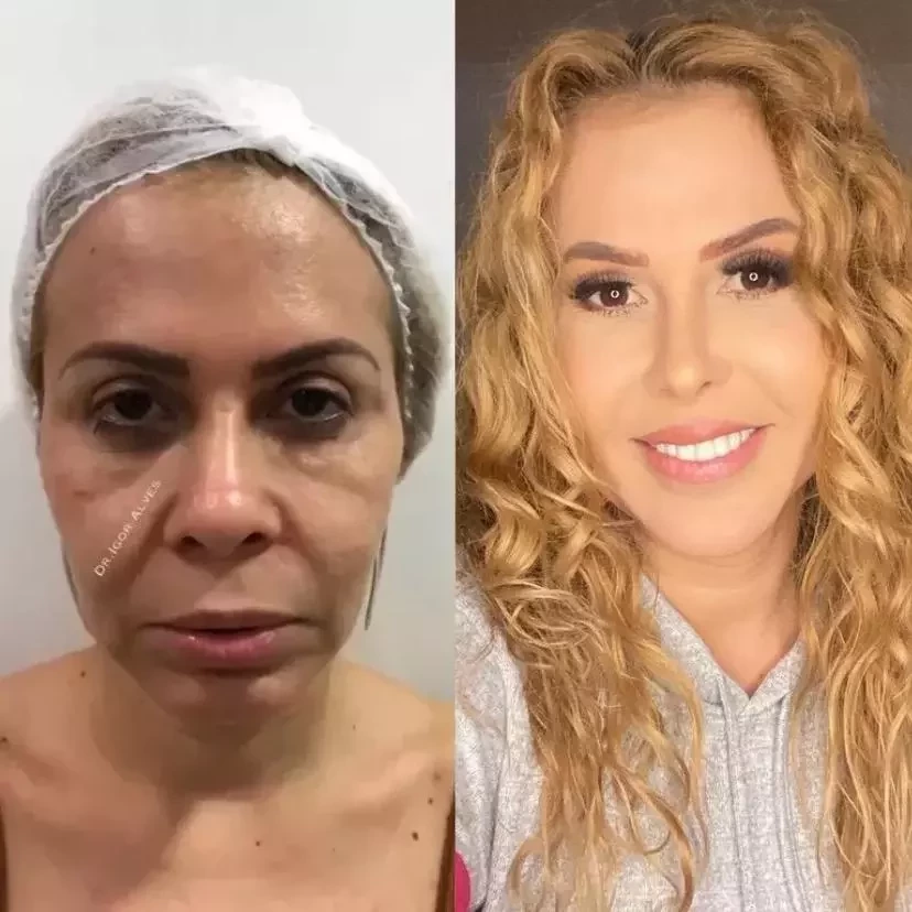 Veja o antes e depois de famosos que fizeram harmonização facial - imagem 49086