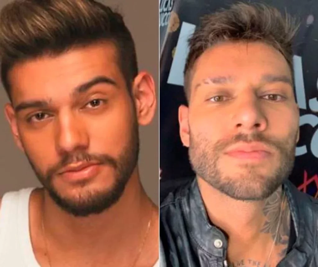 Veja o antes e depois de famosos que fizeram harmonização facial - imagem 49083