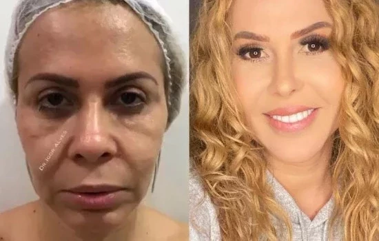 Veja o antes e depois de famosos que fizeram harmonização facial