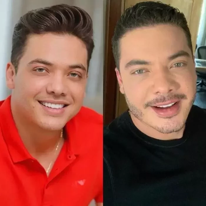 Veja o antes e depois de famosos que fizeram harmonização facial - imagem 49087