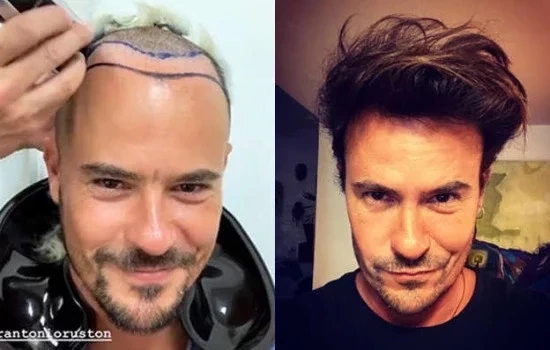 Adeus careca!Veja antes e depois de famosos que fizeram transplante capilar