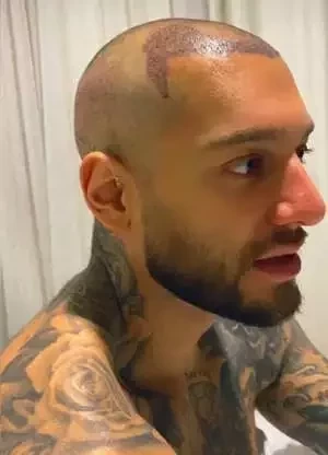 Adeus careca!Veja antes e depois de famosos que fizeram transplante capilar - imagem 53721