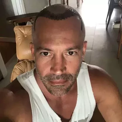 Adeus careca!Veja antes e depois de famosos que fizeram transplante capilar - imagem 53719