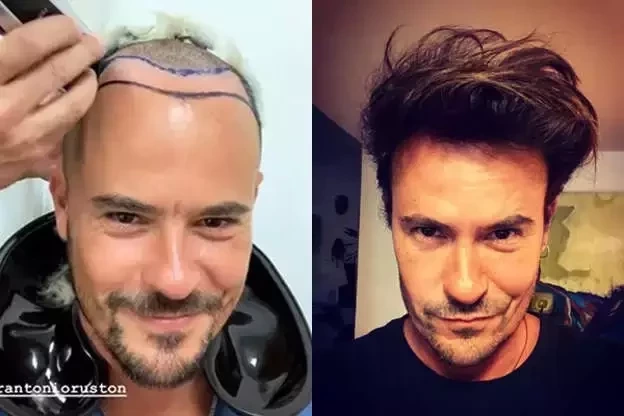 Adeus careca!Veja antes e depois de famosos que fizeram transplante capilar - imagem 53714