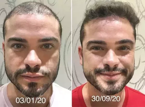 Adeus careca!Veja antes e depois de famosos que fizeram transplante capilar - imagem 53725