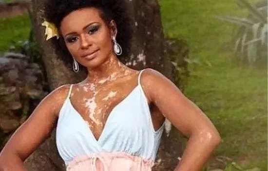 Conheça os famosos que têm vitiligo e  venceram o preconceito