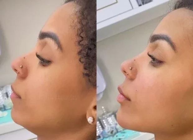 Brunna fez lipo LAD e preenchimentos antes do BBB; saiba quanto ela gastou - imagem 69465