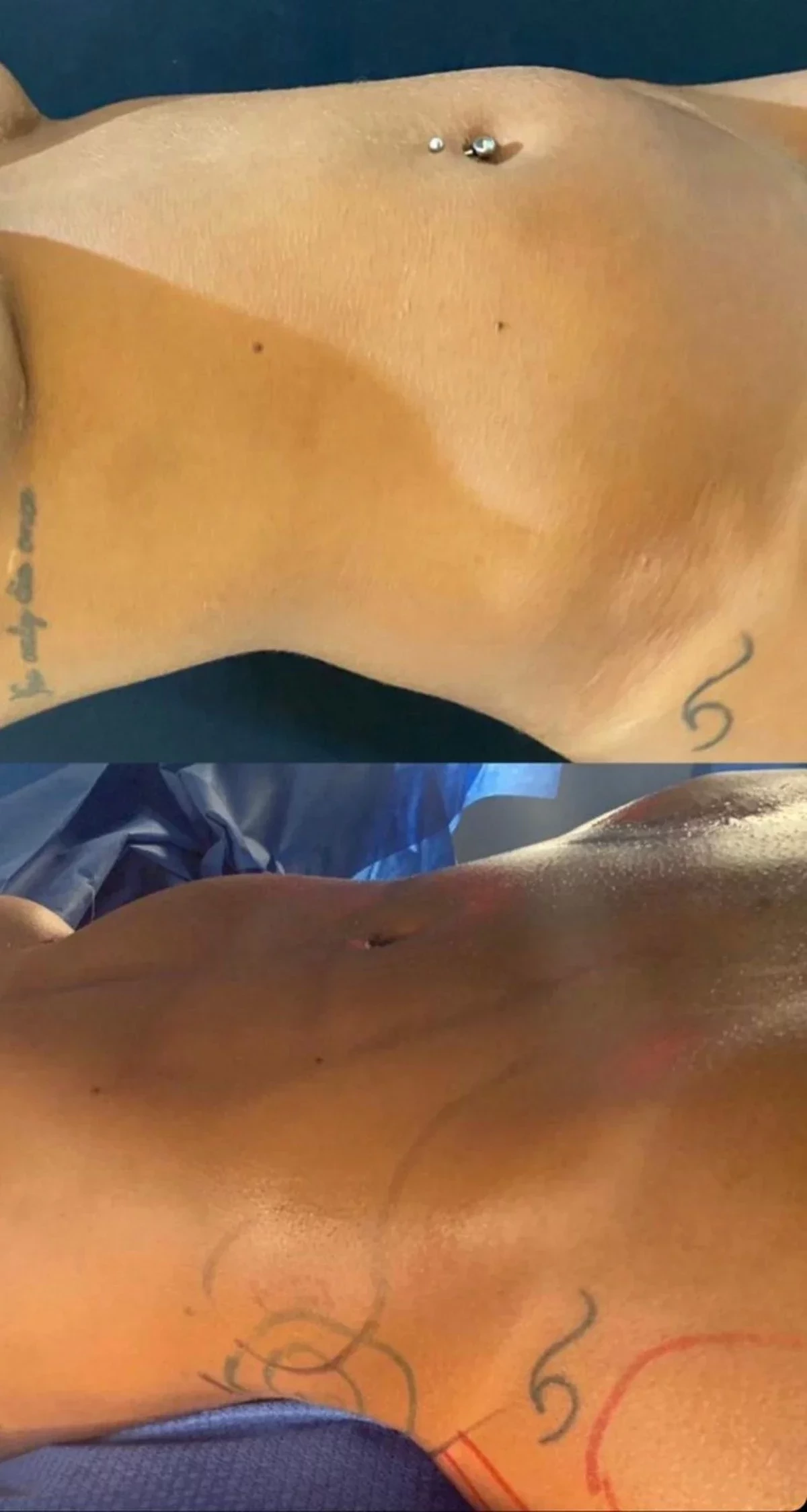 Brunna fez lipo LAD e preenchimentos antes do BBB; saiba quanto ela gastou - imagem 69466