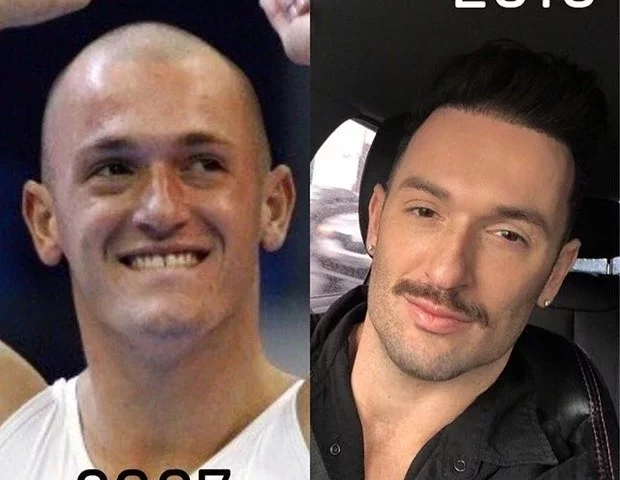 Impressionante! Veja o antes e depois de famosos que fizeram harmonização - imagem 66277