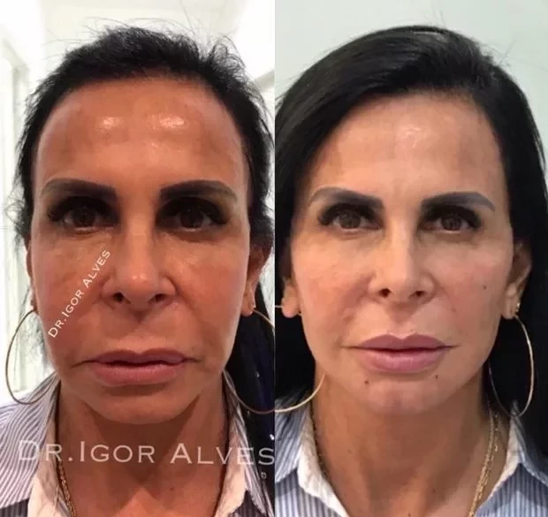 Impressionante! Veja o antes e depois de famosos que fizeram harmonização - imagem 66274