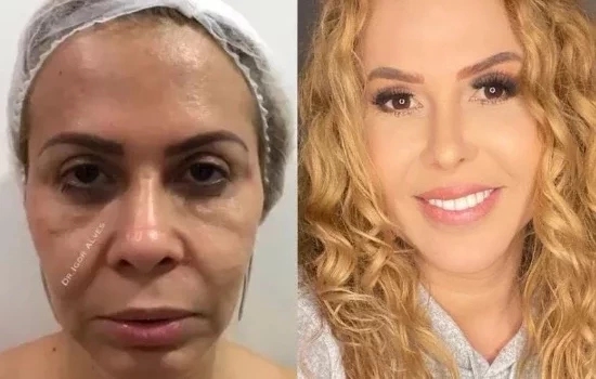Impressionante! Veja o antes e depois de famosos que fizeram harmonização