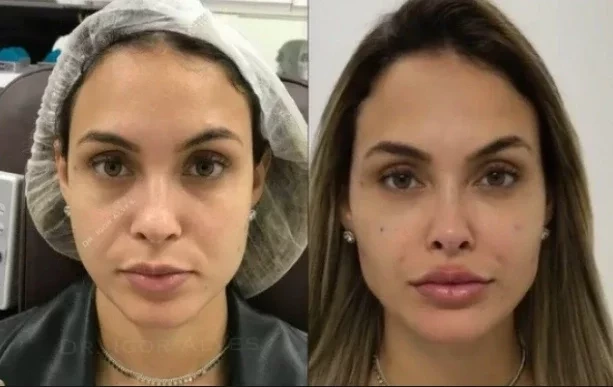 Impressionante! Veja o antes e depois de famosos que fizeram harmonização - imagem 66280