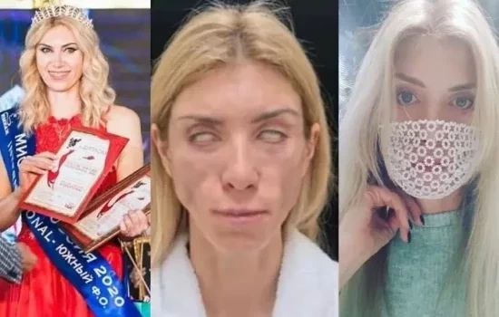 Quem é a miss russa que não consegue fechar os olhos após cirurgia; fotos