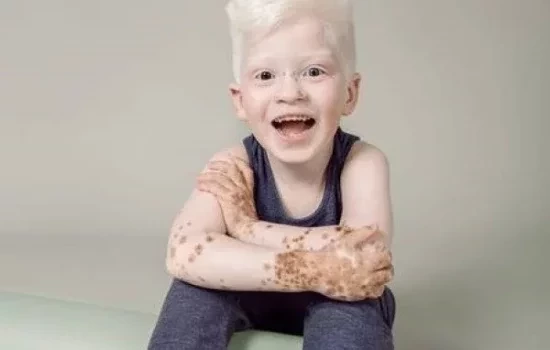 Modelo: Com síndrome rara, menino faz sucesso na web