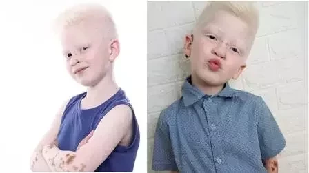 Modelo: Com síndrome rara, menino faz sucesso na web - imagem 75477