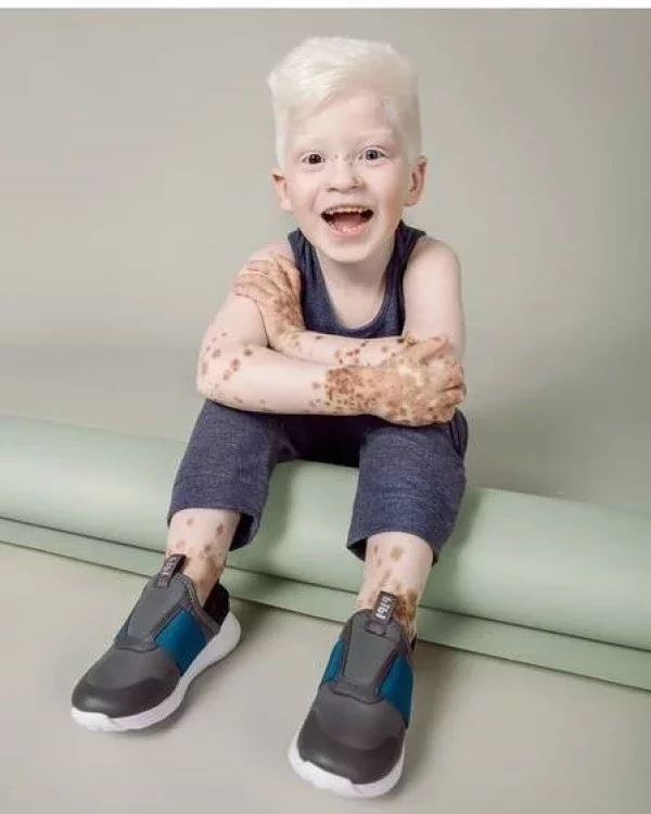 Modelo: Com síndrome rara, menino faz sucesso na web - imagem 75475