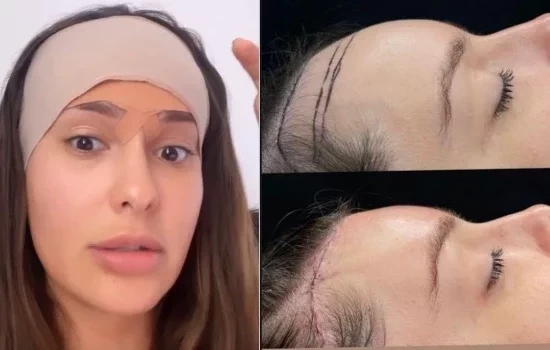 Frontoplastia: entenda cirurgia feita por Thais Braz para diminuir a testa