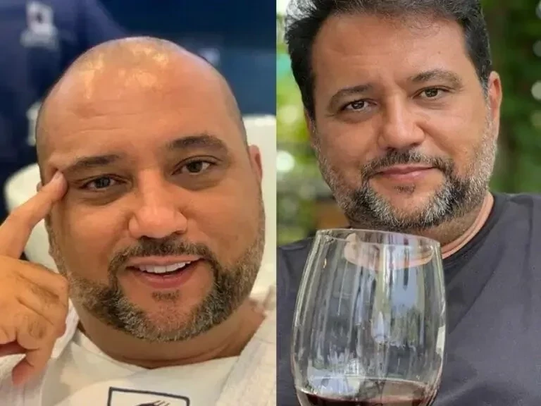 Veja famosos que já fizeram transplante capilar e saiba como ficou - imagem 76751