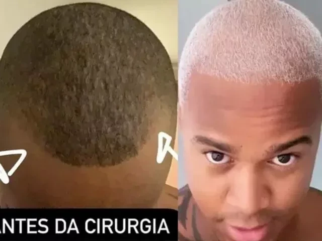 Veja famosos que já fizeram transplante capilar e saiba como ficou - imagem 76750