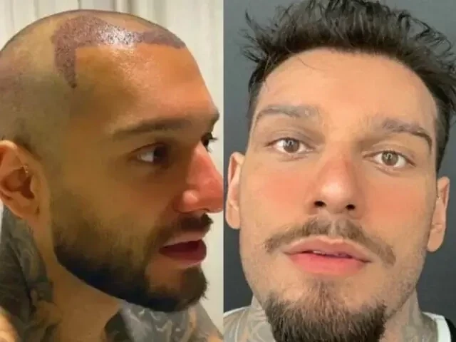 Veja famosos que já fizeram transplante capilar e saiba como ficou - imagem 76725