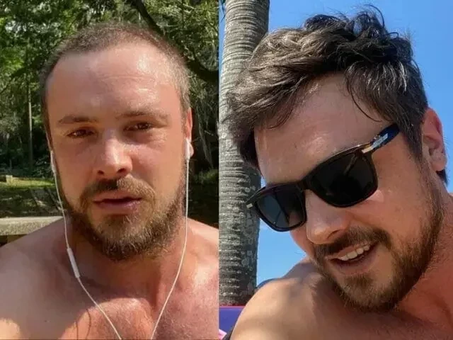 Veja famosos que já fizeram transplante capilar e saiba como ficou - imagem 76755