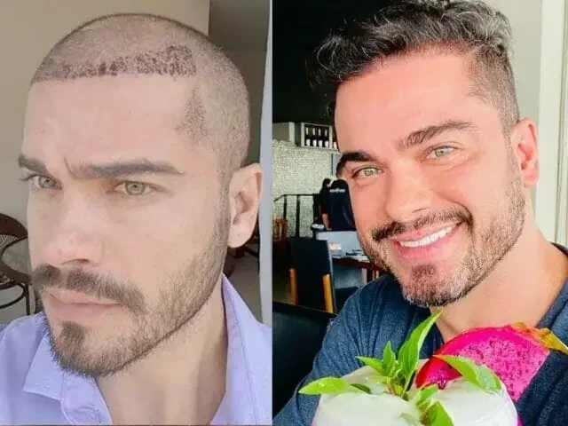 Veja famosos que já fizeram transplante capilar e saiba como ficou - imagem 76756