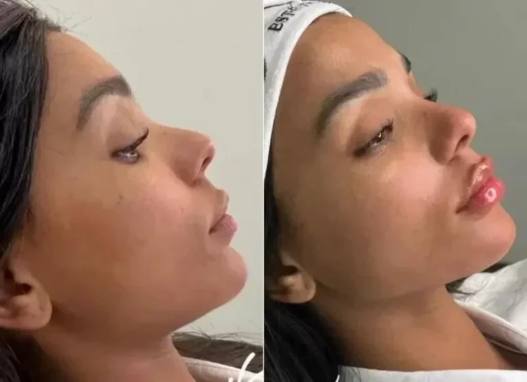 BBB22: veja como ficaram os ex-participantes após procedimentos estéticos  - imagem 83229