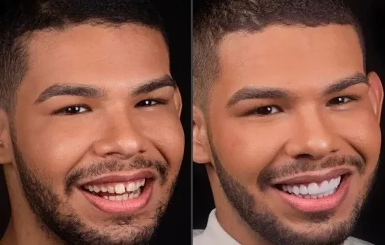 BBB22: veja como ficaram os ex-participantes após procedimentos estéticos 