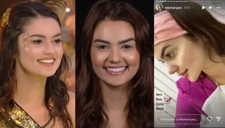 BBB22: veja como ficaram os ex-participantes após procedimentos estéticos  - imagem 83228