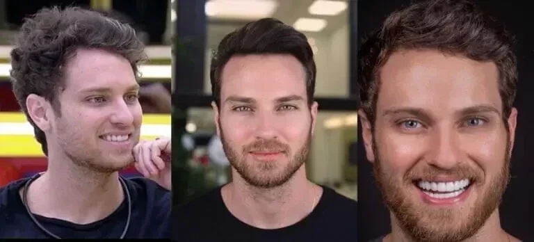 BBB22: veja como ficaram os ex-participantes após procedimentos estéticos  - imagem 83227