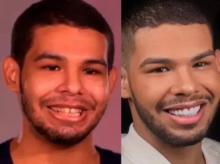 BBB22: veja como ficaram os ex-participantes após procedimentos estéticos  - imagem 83226