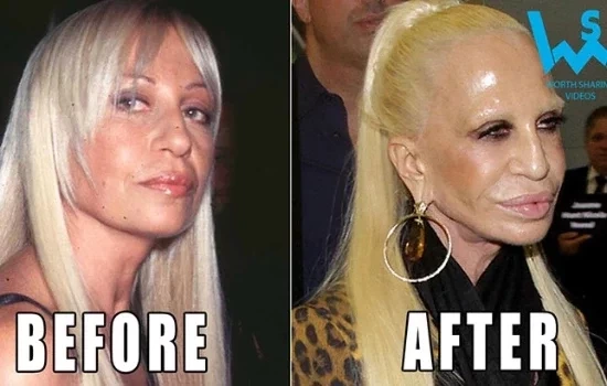 Relembre famosos que ficaram fisicamente arruinados por cirurgias plásticas