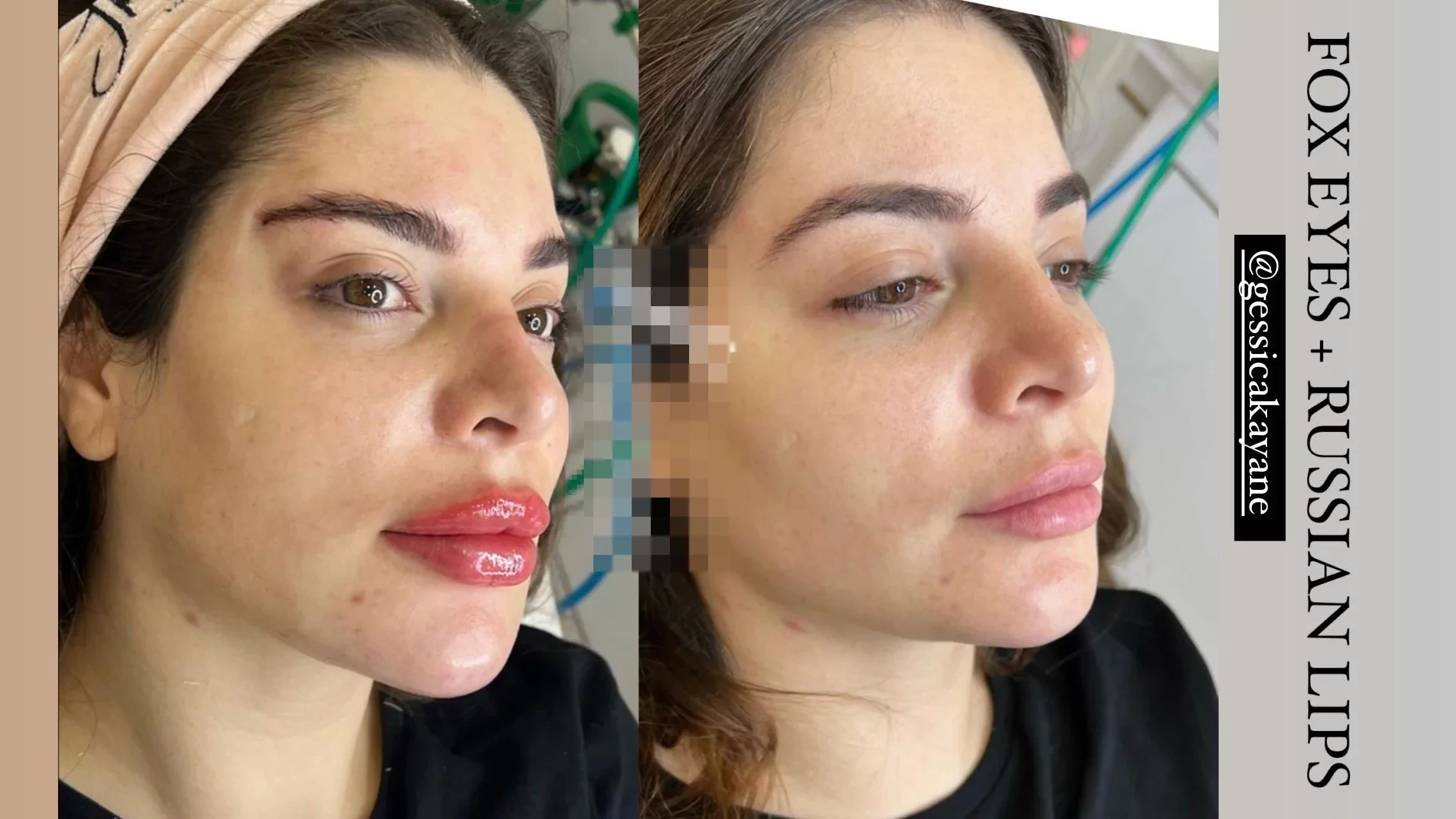 Uma fortuna! Veja quanto Gkay já gastou com procedimentos estéticos - imagem 86592