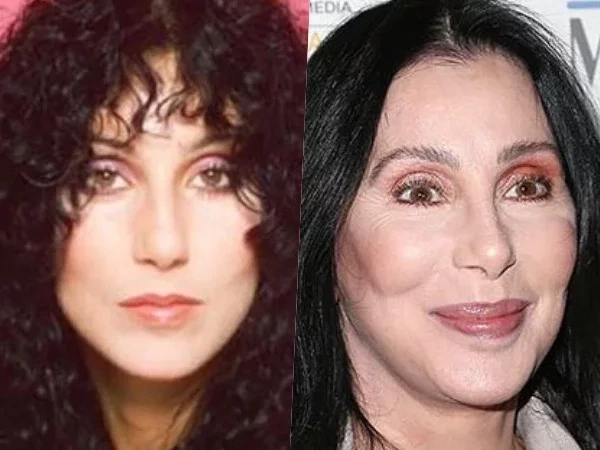 Veja a comparação das fotos de famosos destruídos por cirurgias plásticas