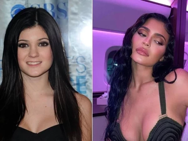 Glow up veio? Veja 10 famosos que mudaram radicalmente após cirurgias